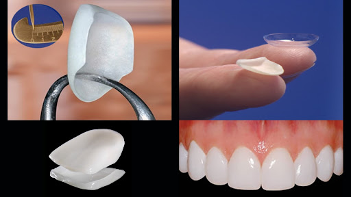 dental-veneers - Newark Family Dental
